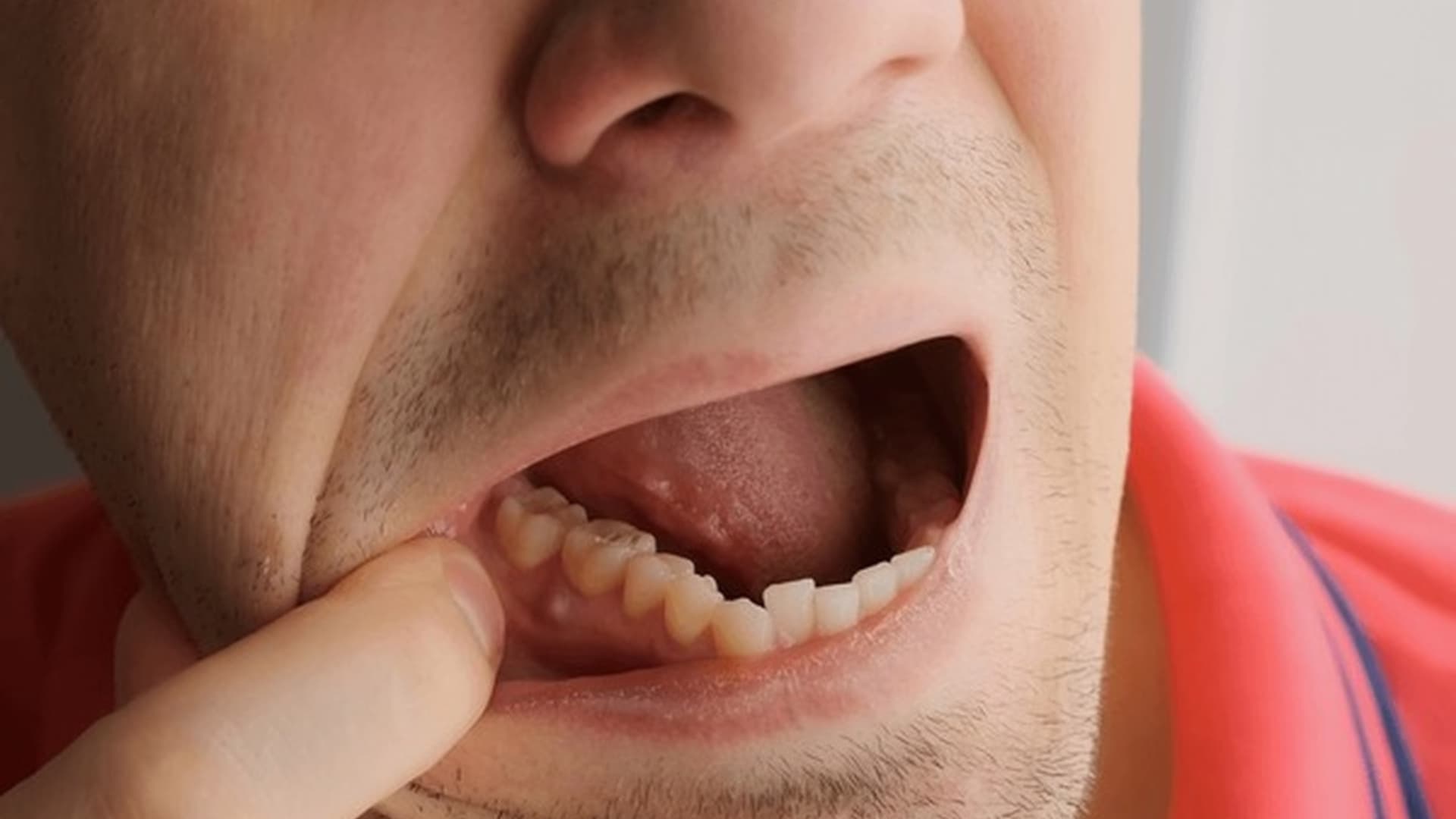 Abscess Formation, 5 Stages of Tooth Decay