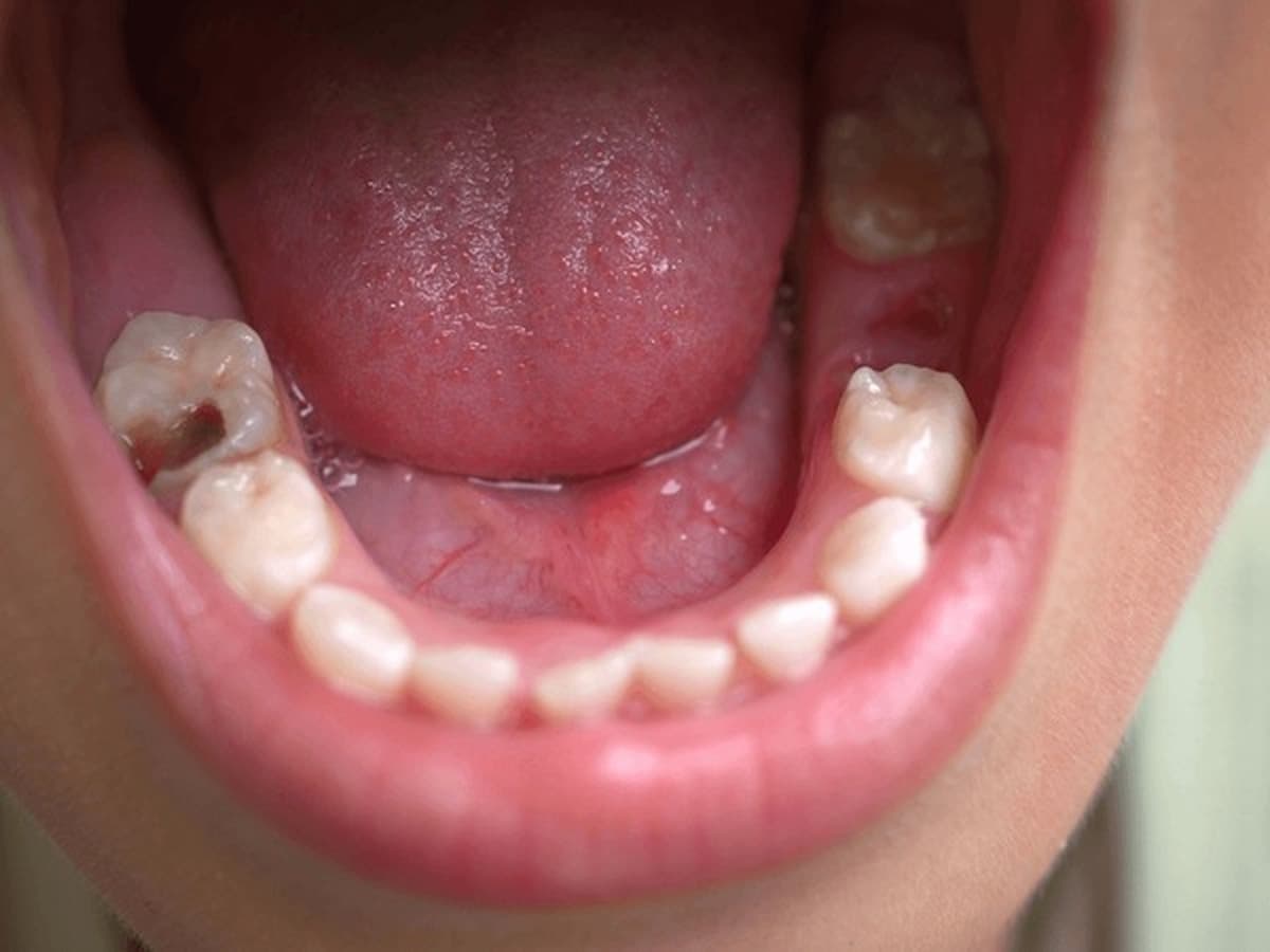 Enamel Decay, 5 Stages of Tooth Decay