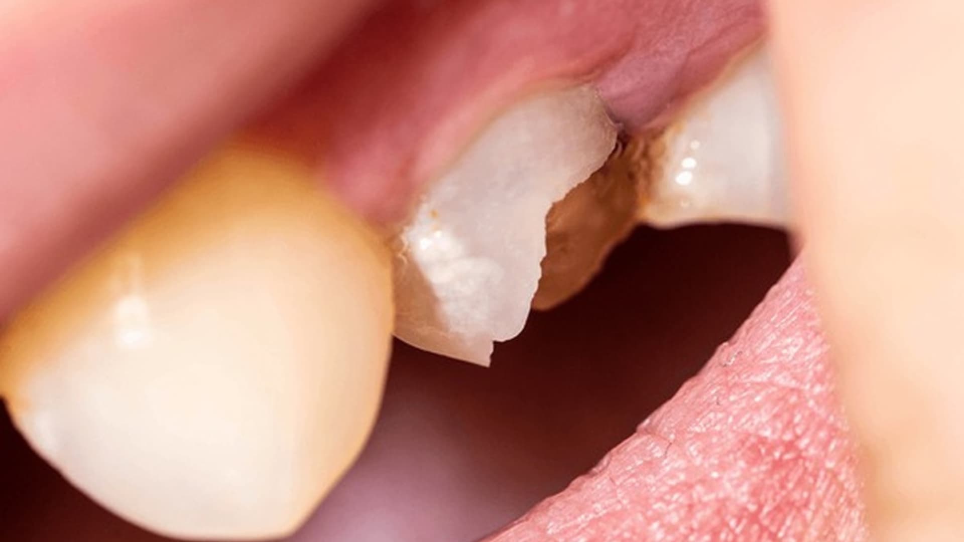 Pulp Damage Pulpitis, 5 Stages of Tooth Decay