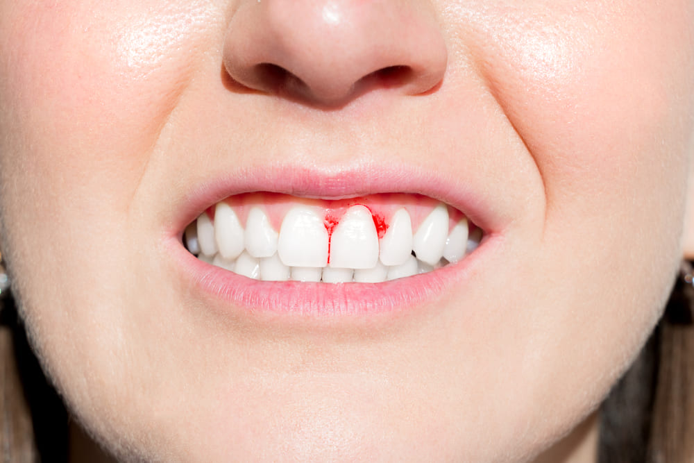 Bleeding gums while smiling, showing a common early warning sign of unhealthy gums.