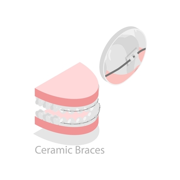 Diagram of ceramic braces on teeth using tooth-colored brackets and orthodontic wire