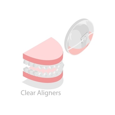 Image of clear aligners fitted over teeth for invisible orthodontic treatment