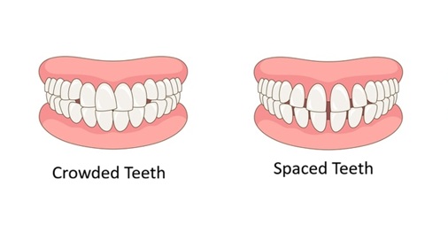 Image of crowded teeth with overlapping alignment and spaced teeth with visible gaps