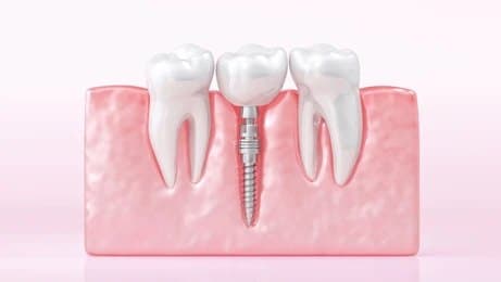 Dental Implant Platinum, Types of Dental Implants