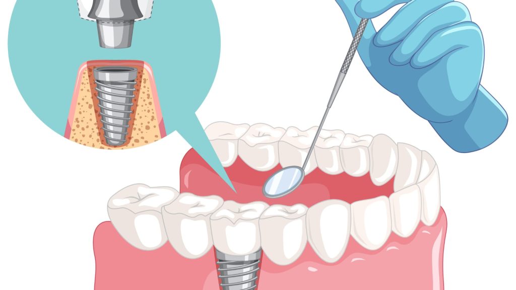 Dental Implant Process,  Type of Dental Implant