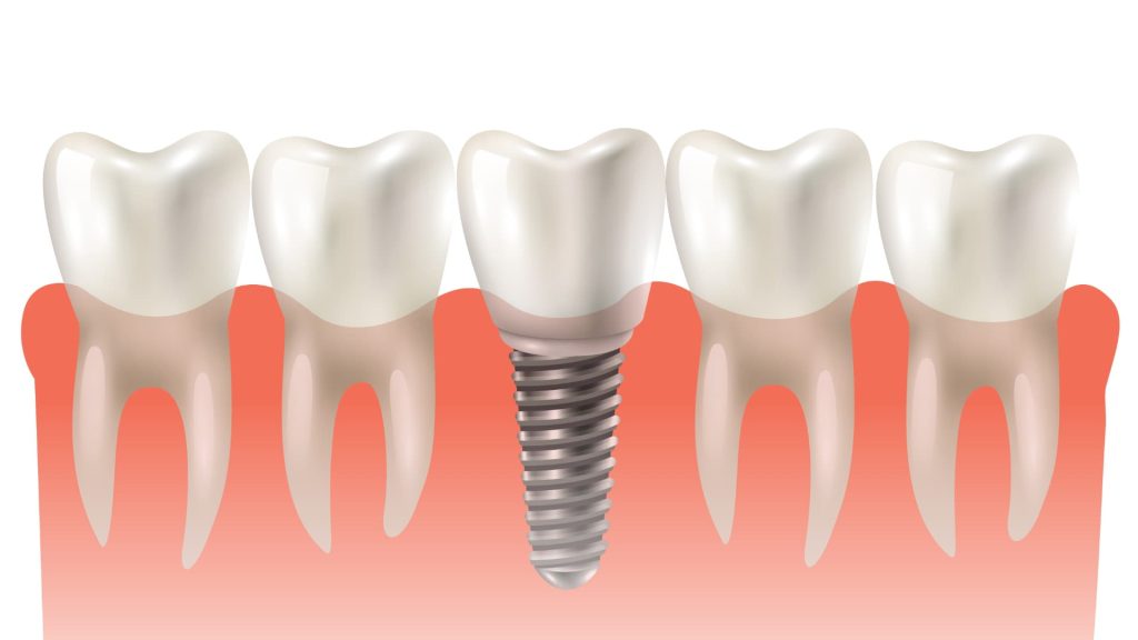 Dental Implants, Types of Dental Implants