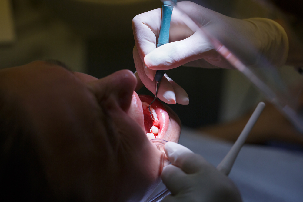 Dental cleaning procedure being performed to treat bleeding gums and remove plaque buildup.