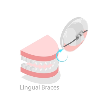 Image of lingual braces placed on the inner side of teeth for hidden orthodontic treatment