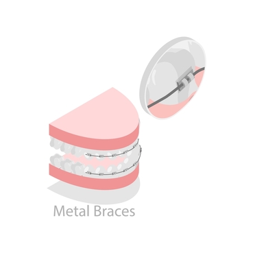 Image of traditional metal braces on teeth with brackets and orthodontic wire