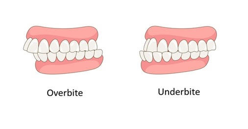 Image of overbite with upper teeth overlapping and underbite with lower teeth extending forward