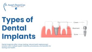 Types of Dental Implants