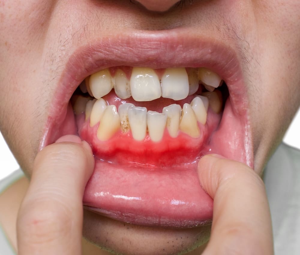 Gum inflammation and redness along the lower gumline consistent with gingivitis.
