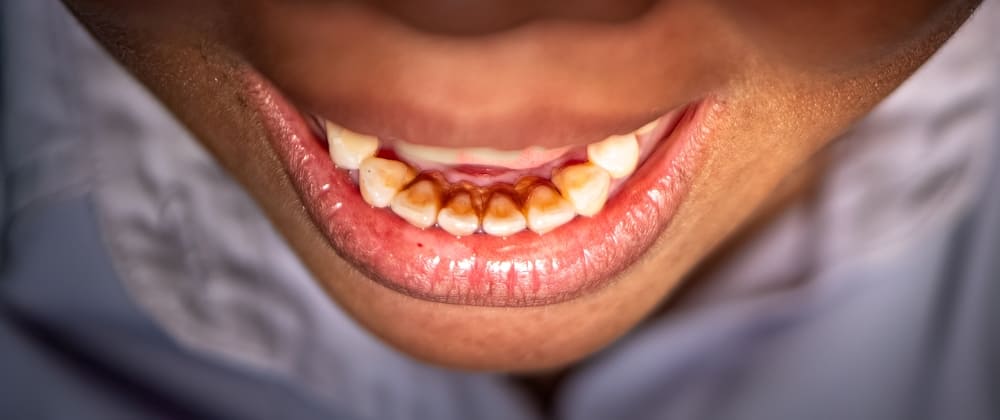 Plaque and tartar buildup on lower teeth near the gumline causing gum irritation.