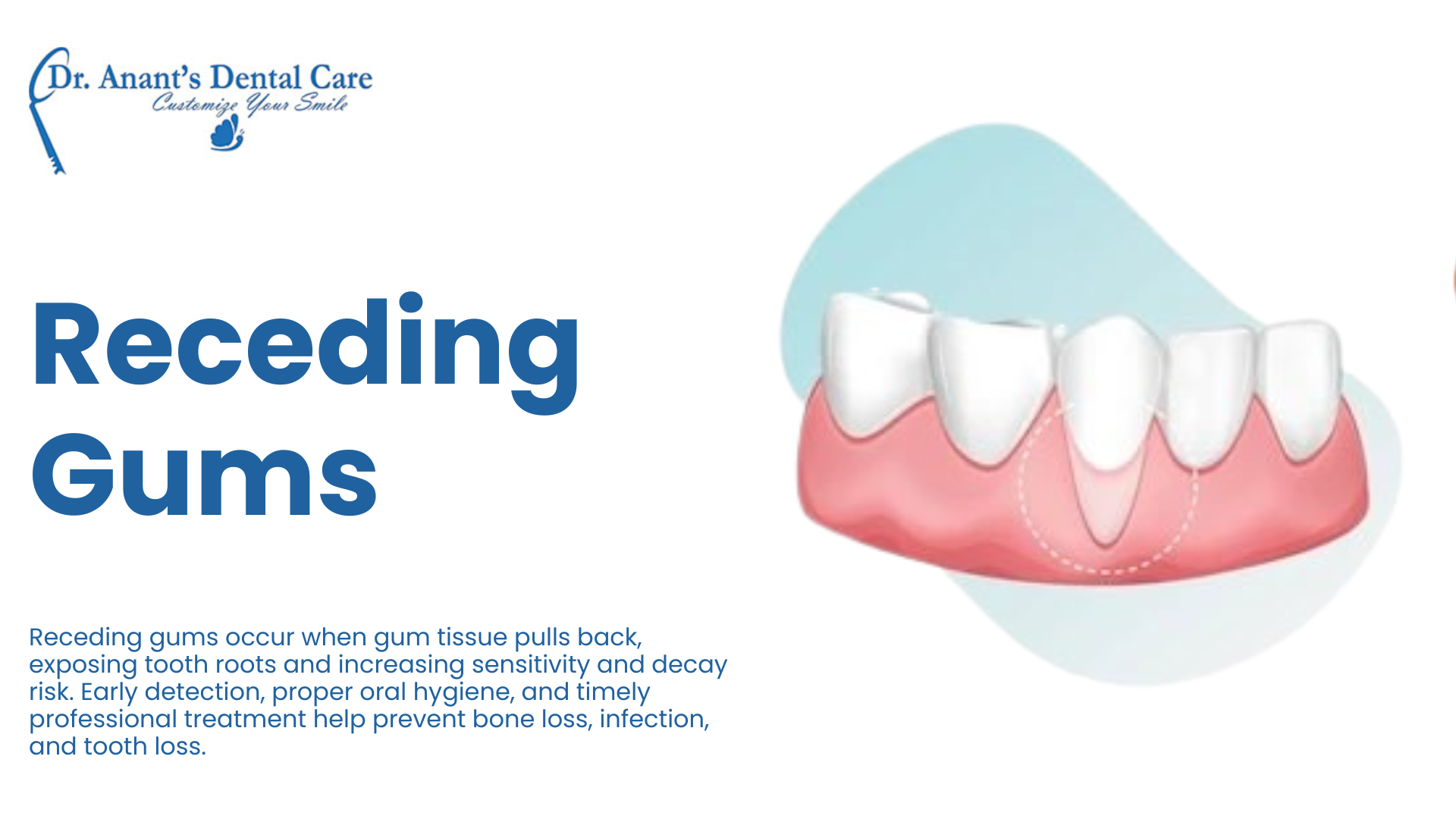Receding Gums