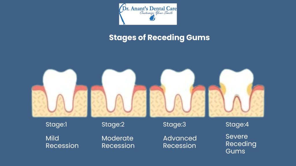 Stages of Receding Gums