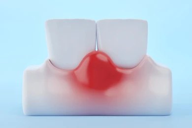Swollen Gums, Swollen Gums Treatment