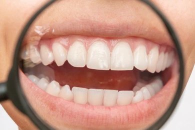 White spots on teeth, White Spots on Teeth
