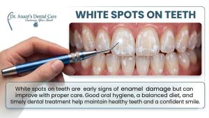 White spots on teeth