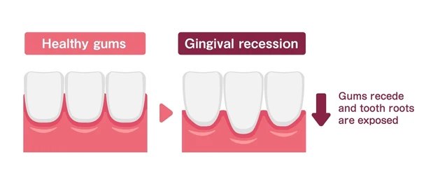 Receding Gums