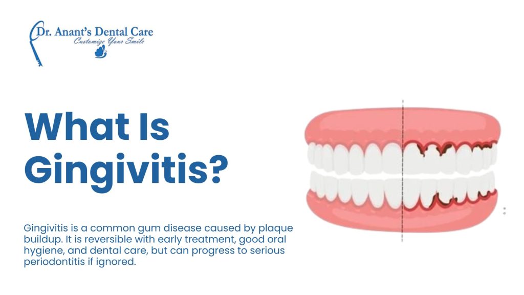 What Is Gingivitis?