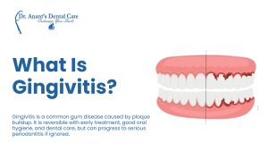 What Is Gingivitis?