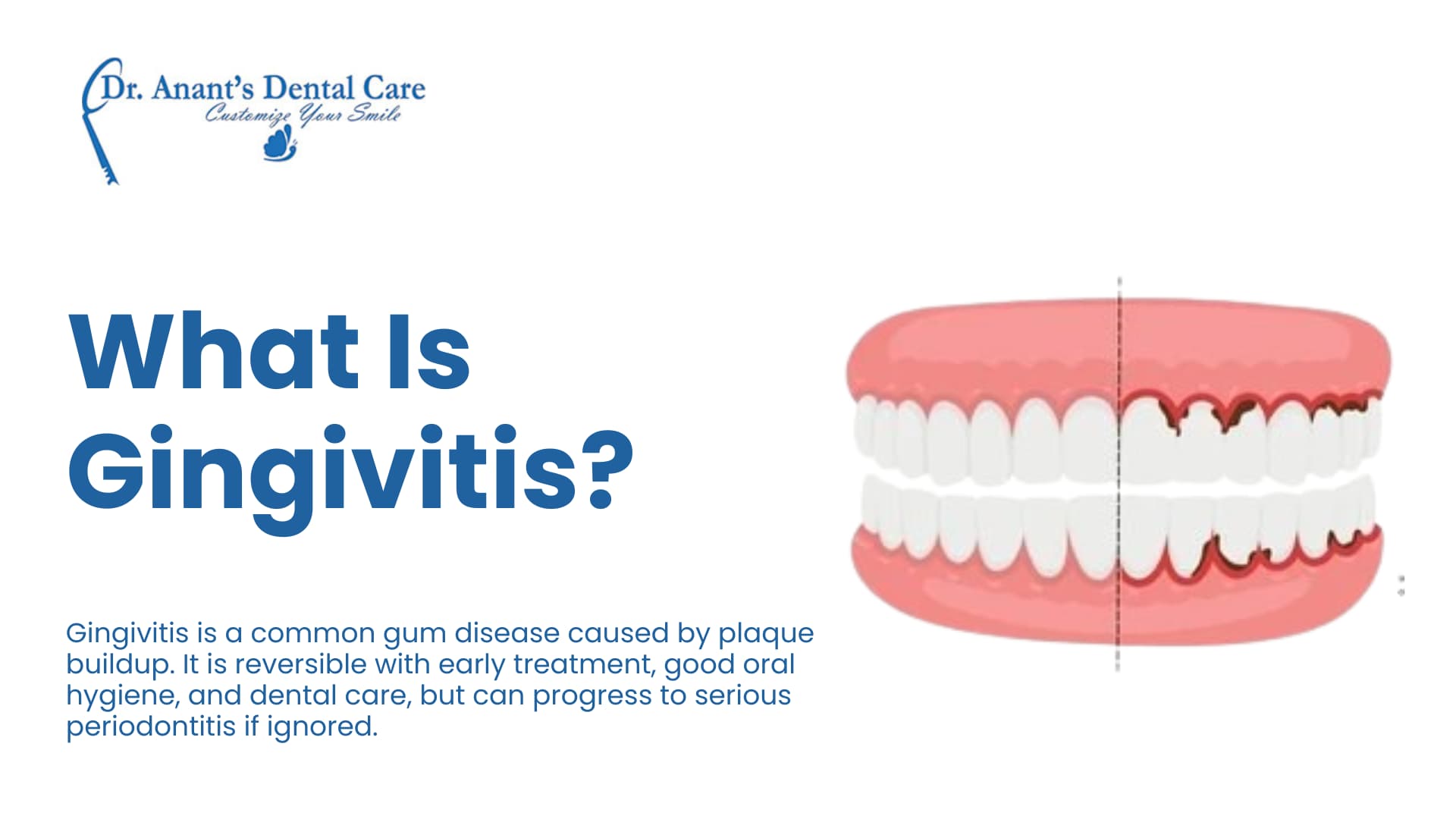 What Is Gingivitis?