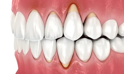 Gingivitis, 