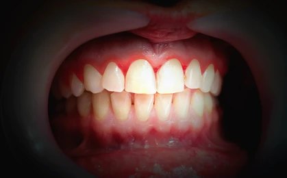 Gum Bleeding