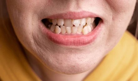 Crooked Teeth 