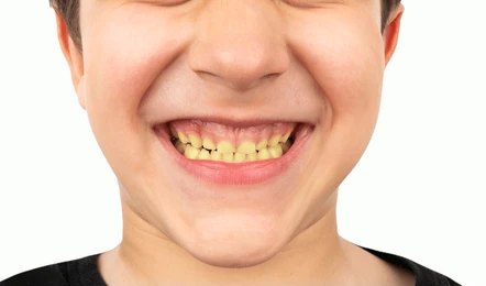  Yellow Teeth