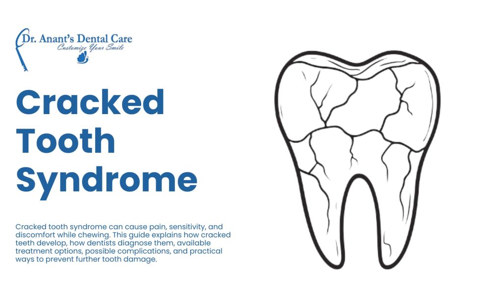 Cracked Tooth Syndrome