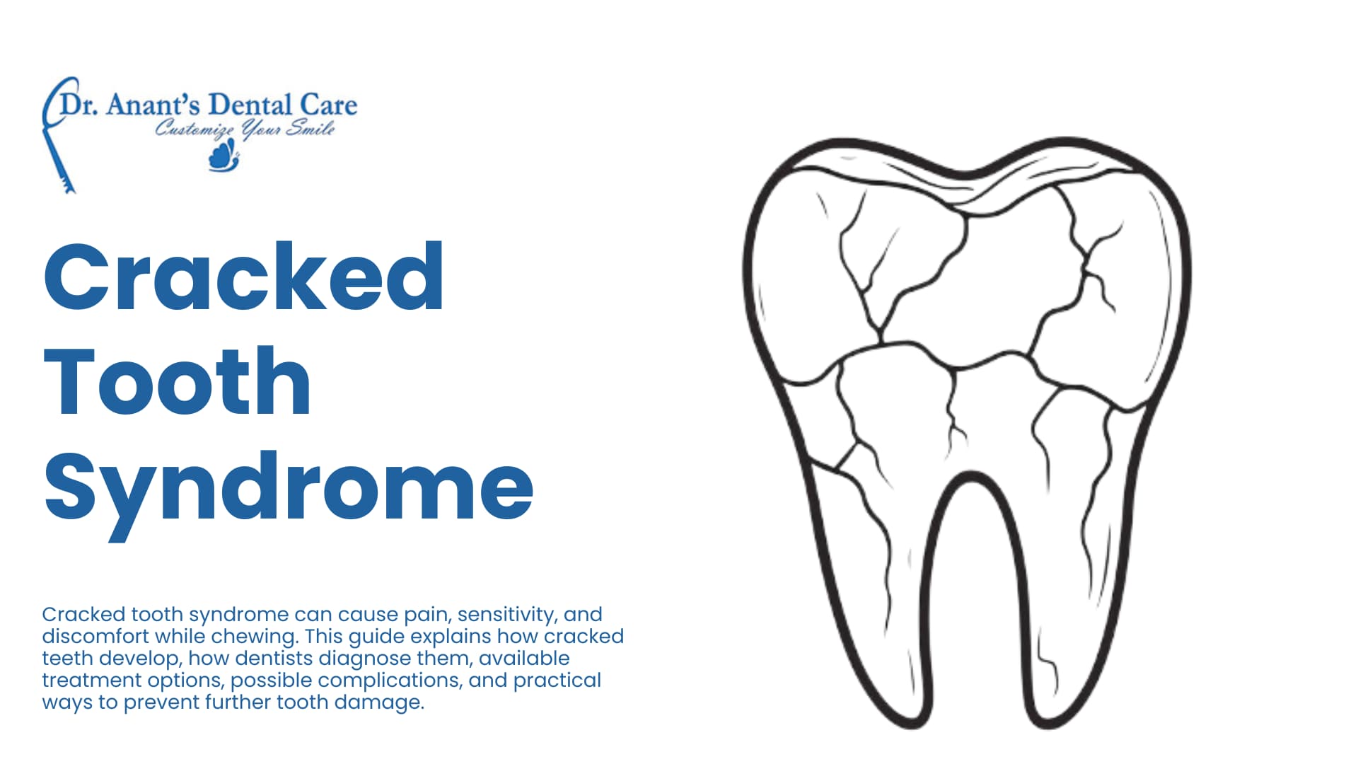 Cracked Tooth Syndrome
