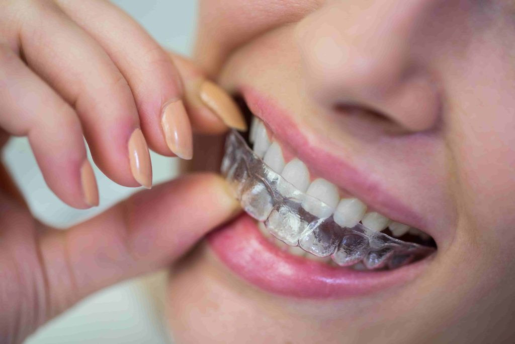Aligners, Aligners and Braces