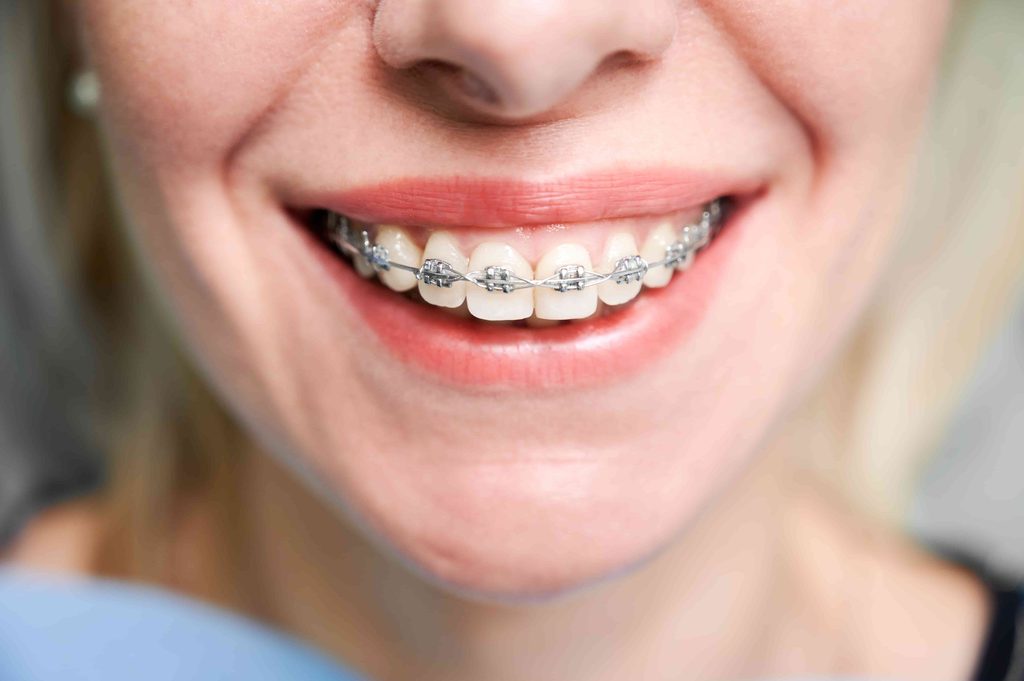 Braces, Aligners vs Braces