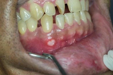 White Spots on Gums